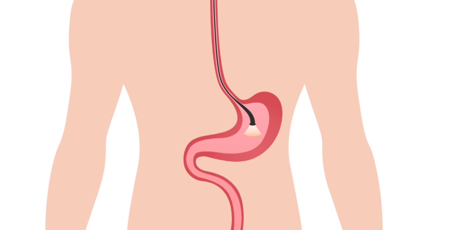 Gastroscopy