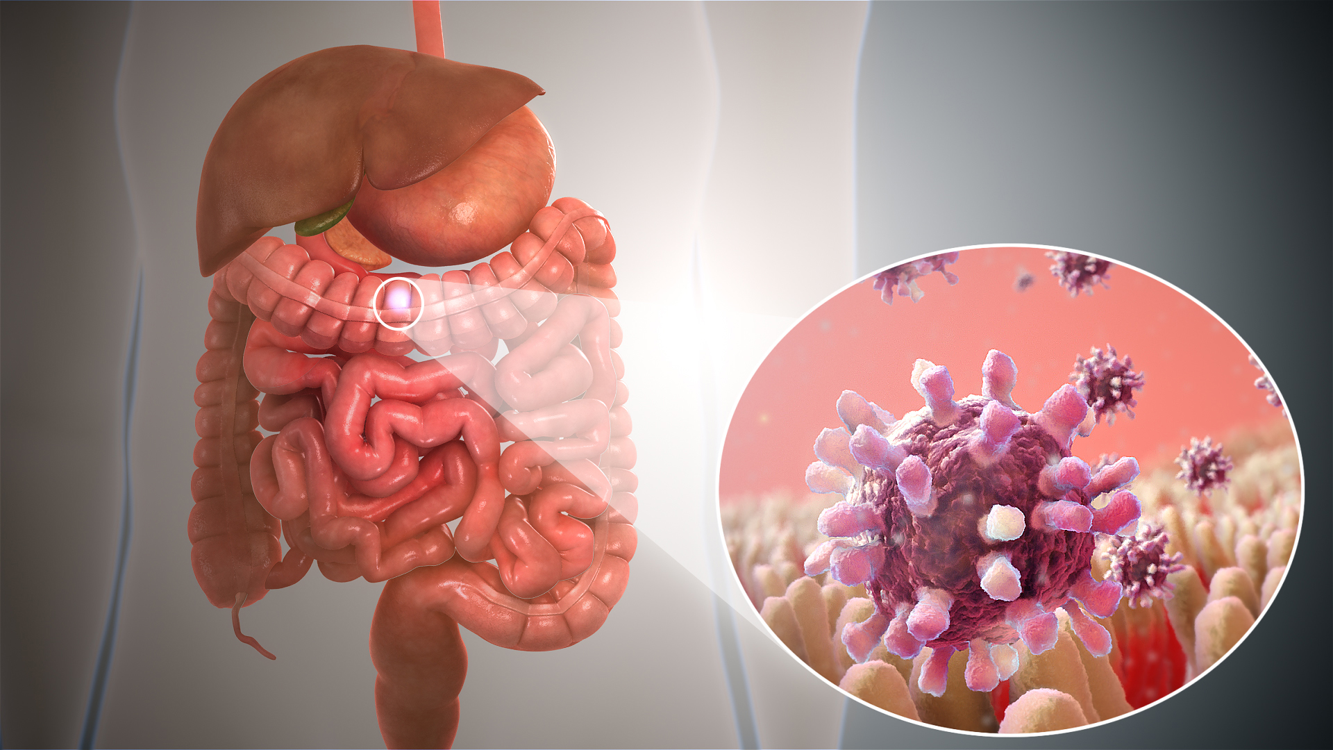 Gastroenteritis and other gut infections treatment in dubai