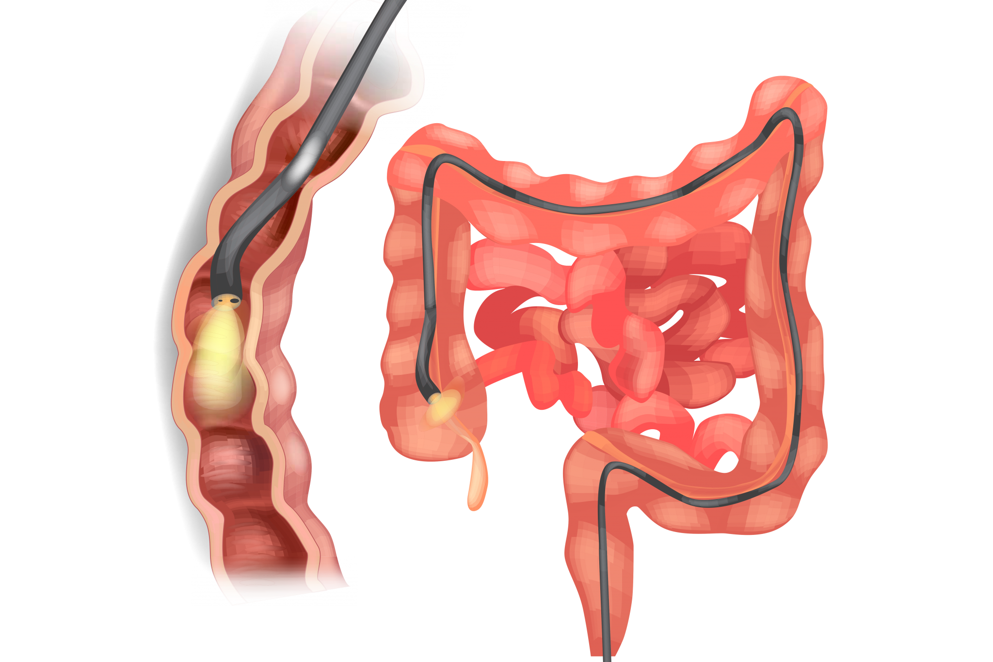 colonoscopy in dubai