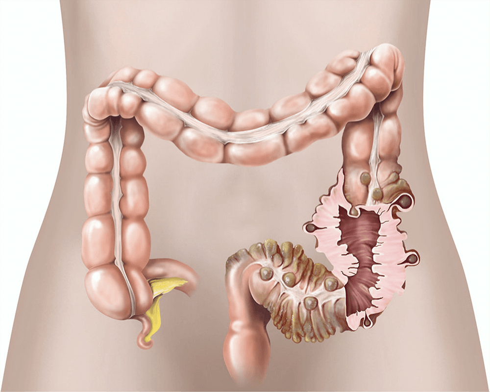 Diverticular Disease and Diverticulitis Treatment in Dubai