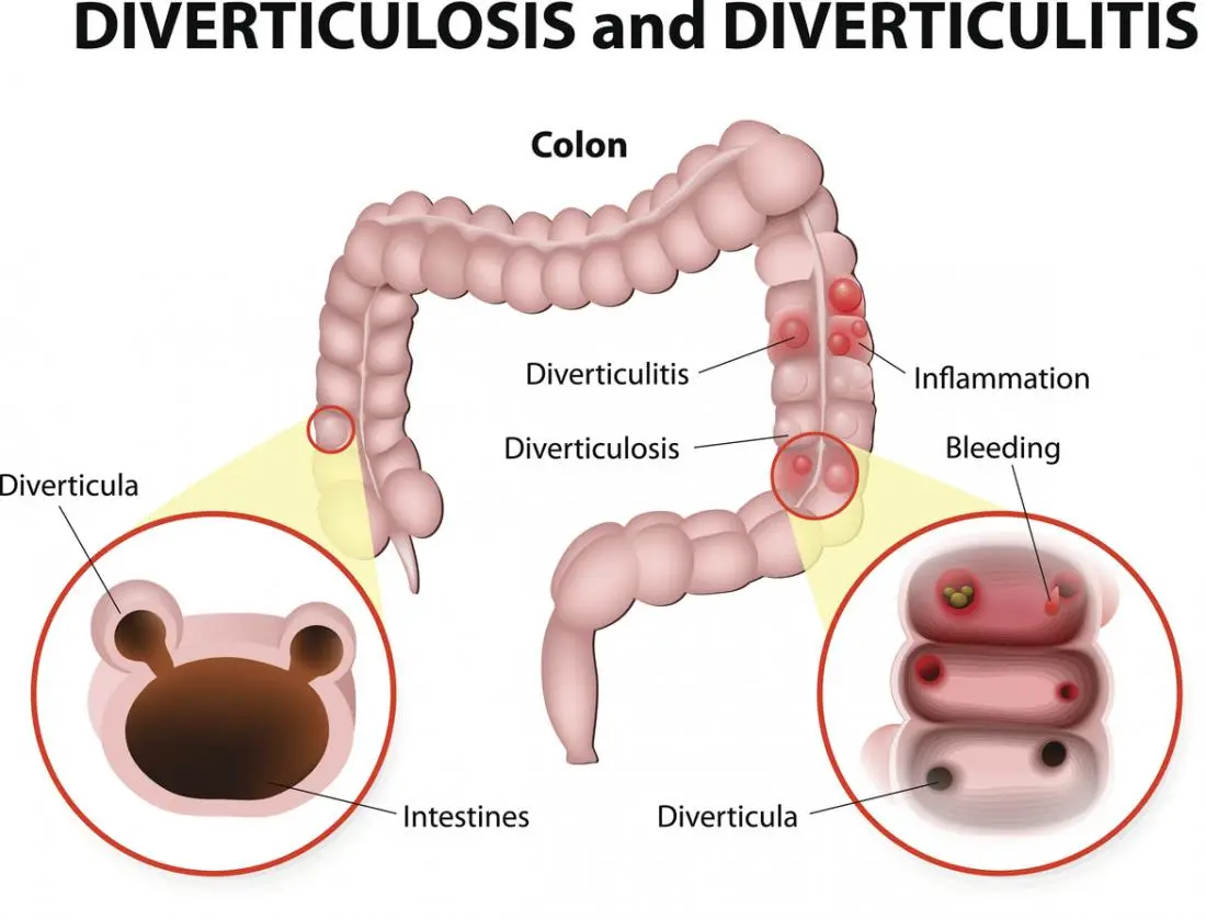 diverticulitis and diverticulosis treatment in Dubai