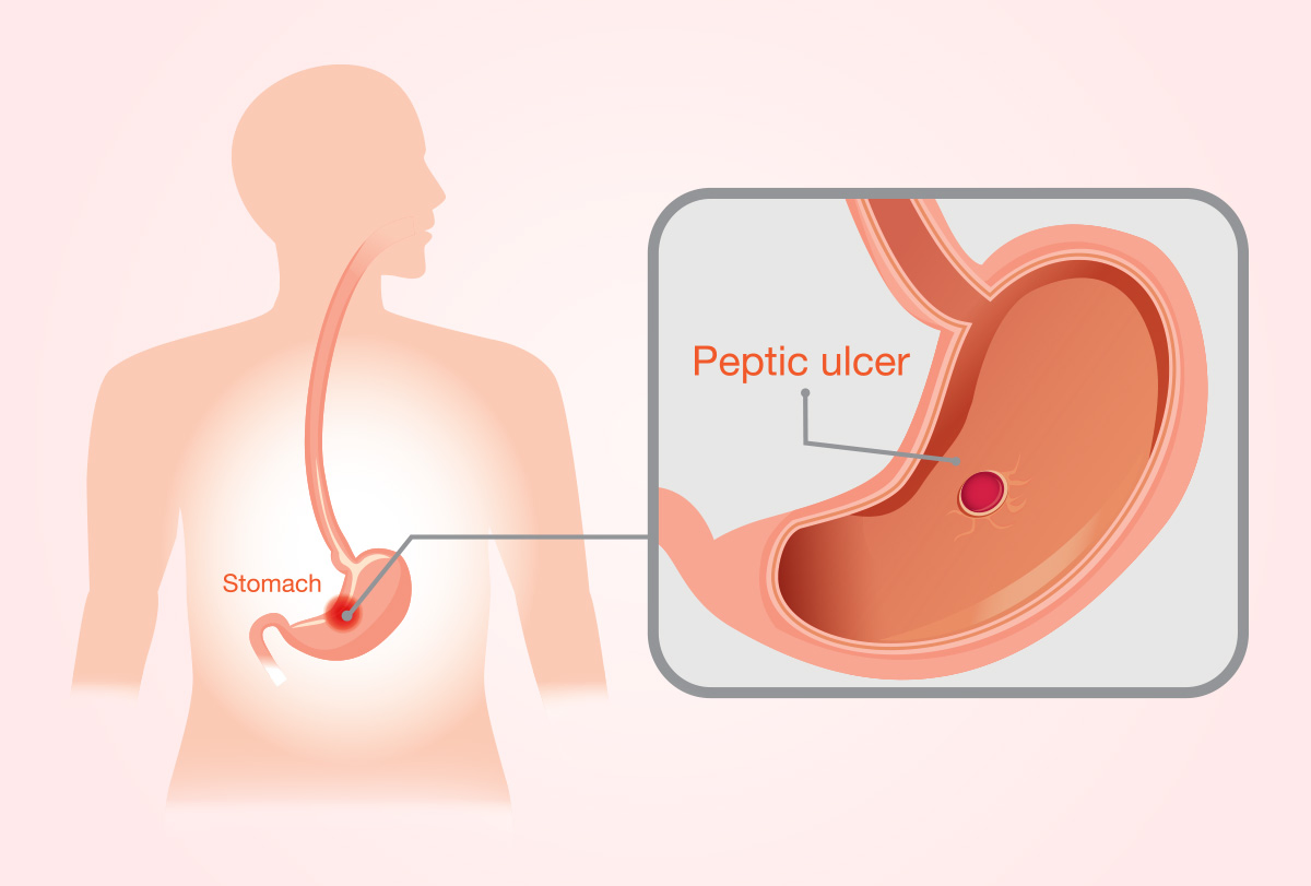 stomach-ulcers treatment in Dubai