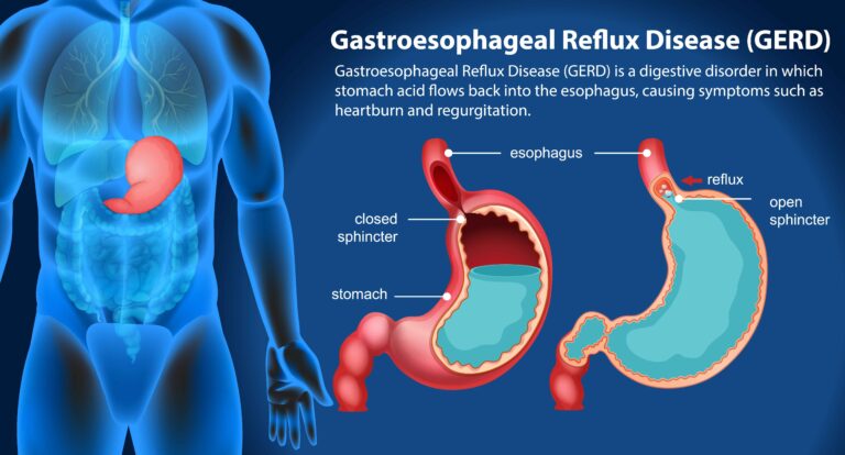 Gastroesophageal Reflux Disease (GERD): Understanding Symptoms, Causes, and Effective Treatments